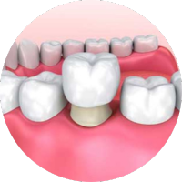 Bước 3: Gắn phục hình - Điều chỉnh