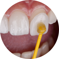 Bước 4: Gắn răng